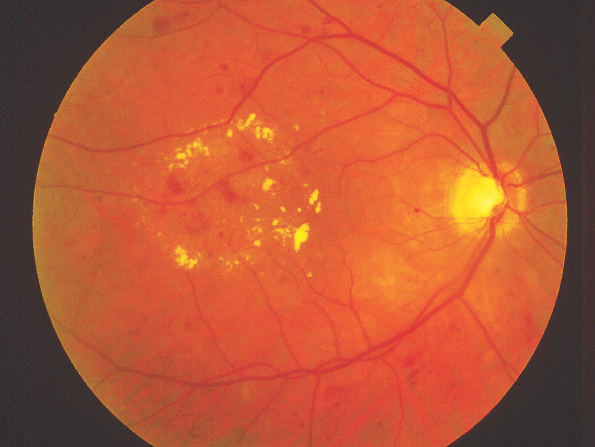 Diabetic retinopathy can cause permanent vision loss.
